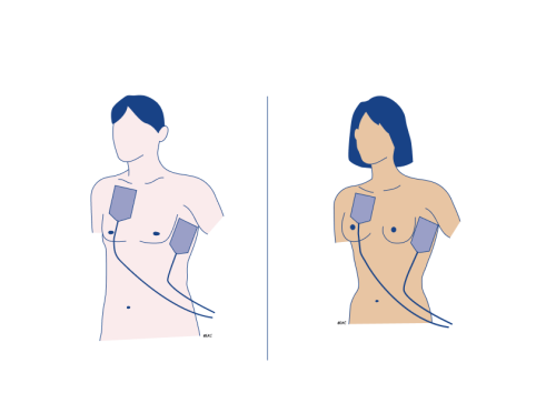 Anterior-Lateral Pad Position